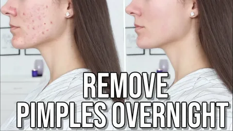 How to Remove Pimples Overnight: Effective Methods for Clear Skin 2025